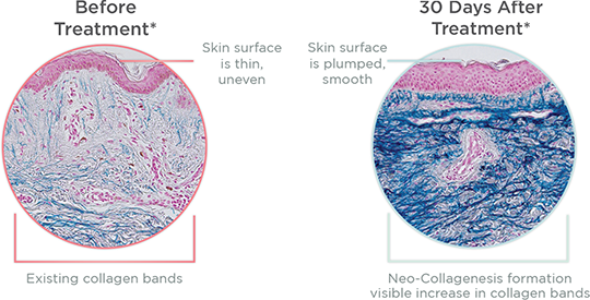 Collagen Reshaping