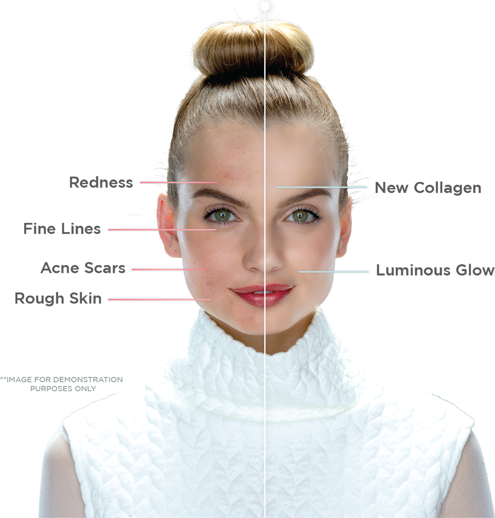 portrait photo with left side of face before treatment, right side after treatment. Redness is reduced, fine lines, acne scars and rough skin are all improved significantly on right side. Image for demonstration purposes only.